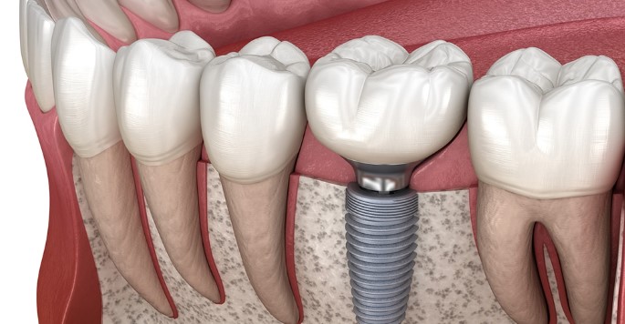 Smile Confidently Again: The Benefits of Dental Implants for Restoring Your Missing Teeth