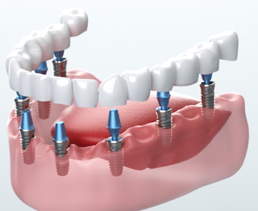 Smile Confidently Again The Benefits Of Dental Implants For Restoring Your Missing Teeth, Grin Assuredly Once More The Advantages Of Tooth Implants For Renewing Your Absent Teeth, Beaming With Confidence The Pros Of Dental Implants For Enhancing Your Smile, Radiate SelfAssurance Anew The Benefits Of Dental Implants For Replacing Missing Teeth, Restore Your Smile